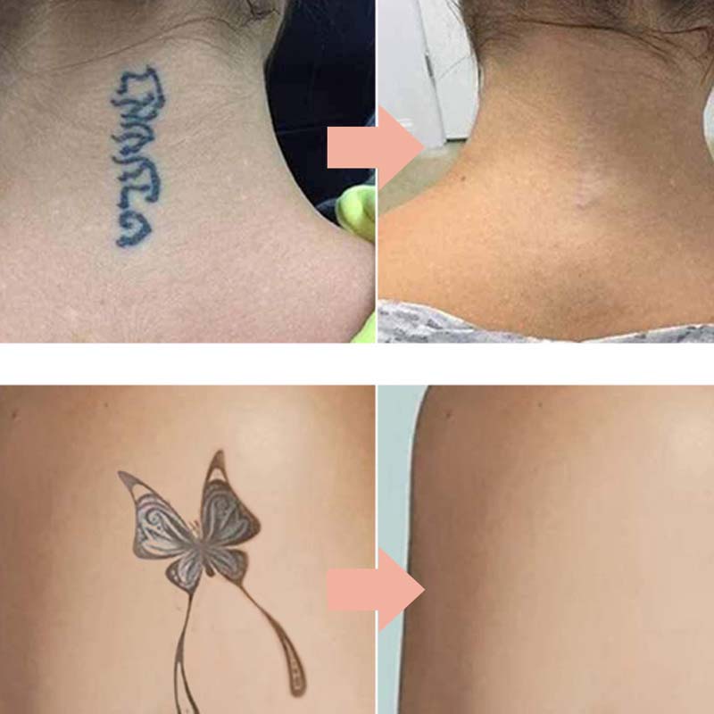 🥳2026 HOT SALE🥳💞50K+ SOLD!🧴✨ 50% OFF! Multi‑Use Tattoo Fading Cream – Works on body & cosmetic ink. Gentle plant formula, visible results in weeks. Say goodbye to laser! 🌿💪